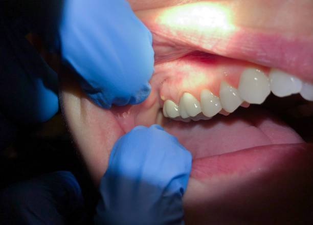 Best Urgent Care for Lost Fillings or Crowns in Lewisville, NC